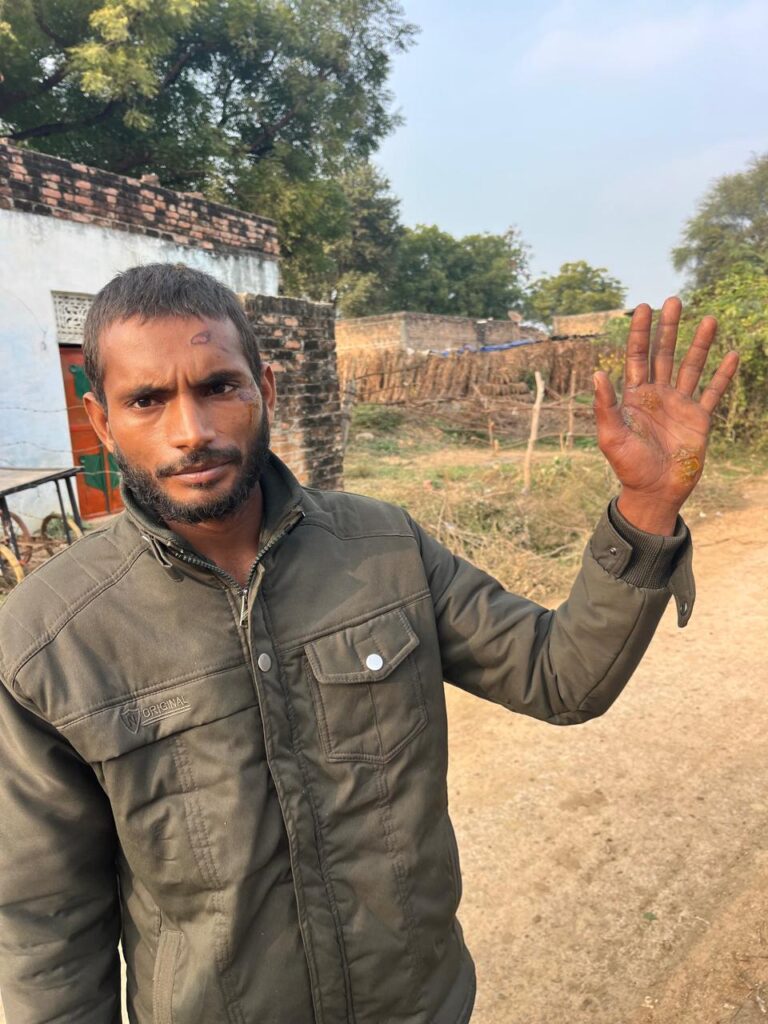 समथर — थाना क्षेत्र के ग्राम बुडेराघाट में हाइटेंशन लाइन की चपेट में आया ग्रामीण, बाल बाल बचा, आमजन में आक्रोश